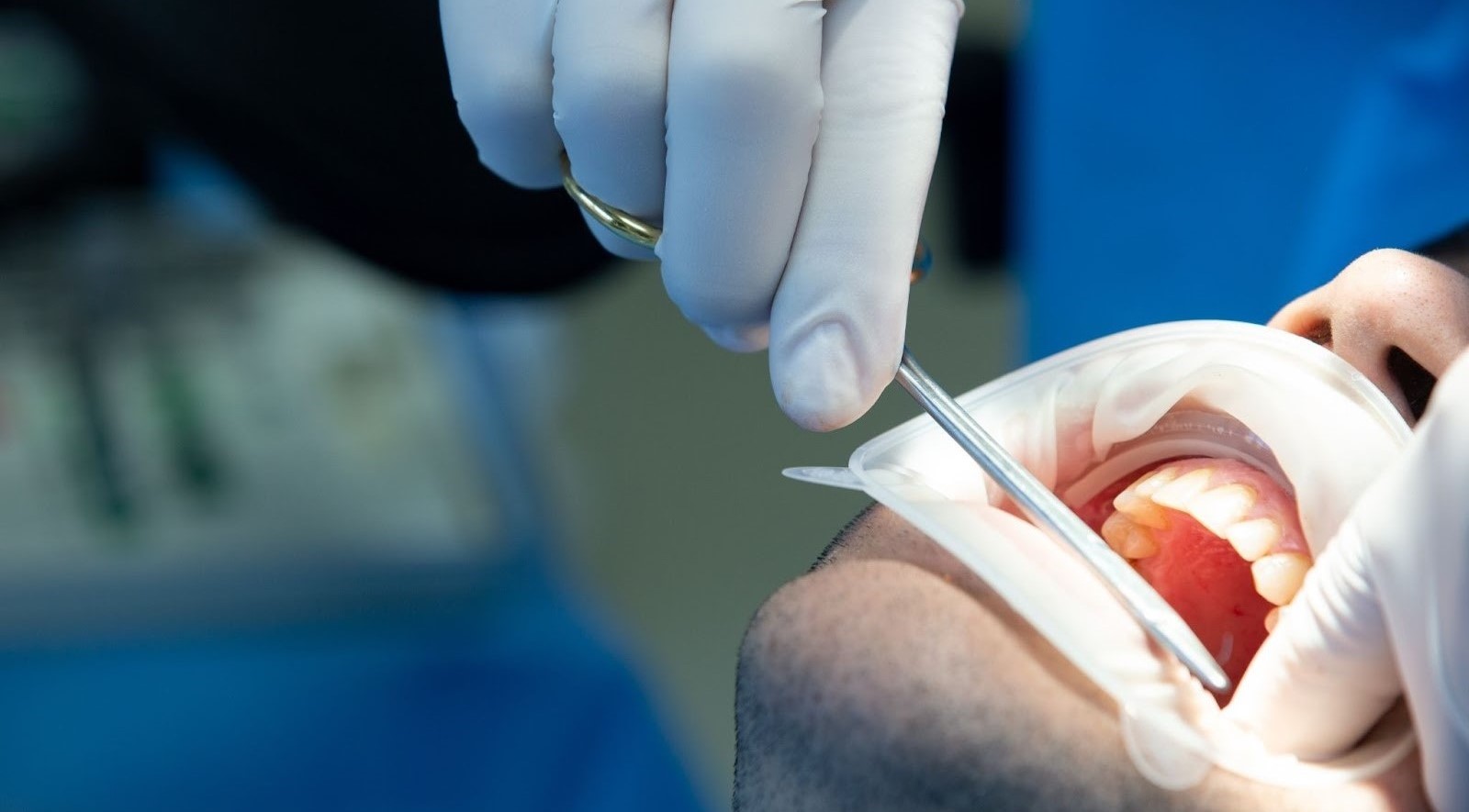 Root Canal Treatment in Lucknow: Myths vs Facts