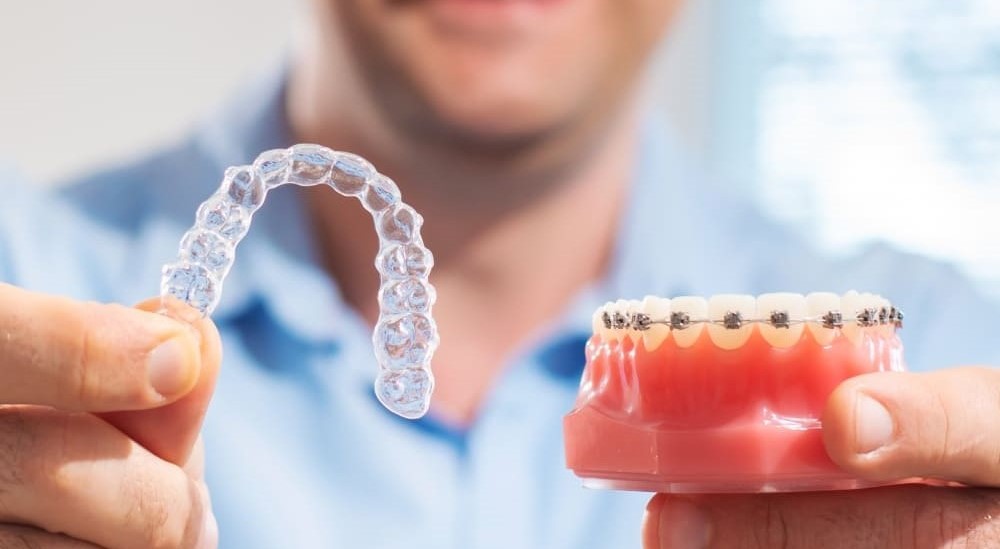 Braces vs Clear Aligners in Lucknow: Which Is Better?