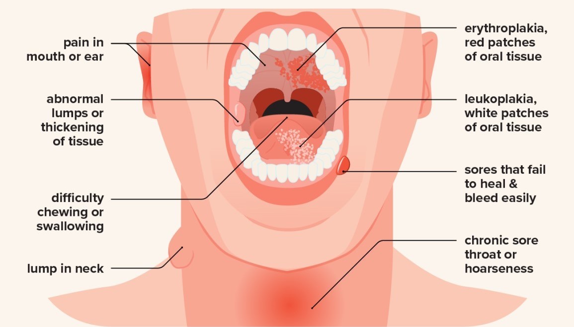 dentist performing oral cancer screening examination