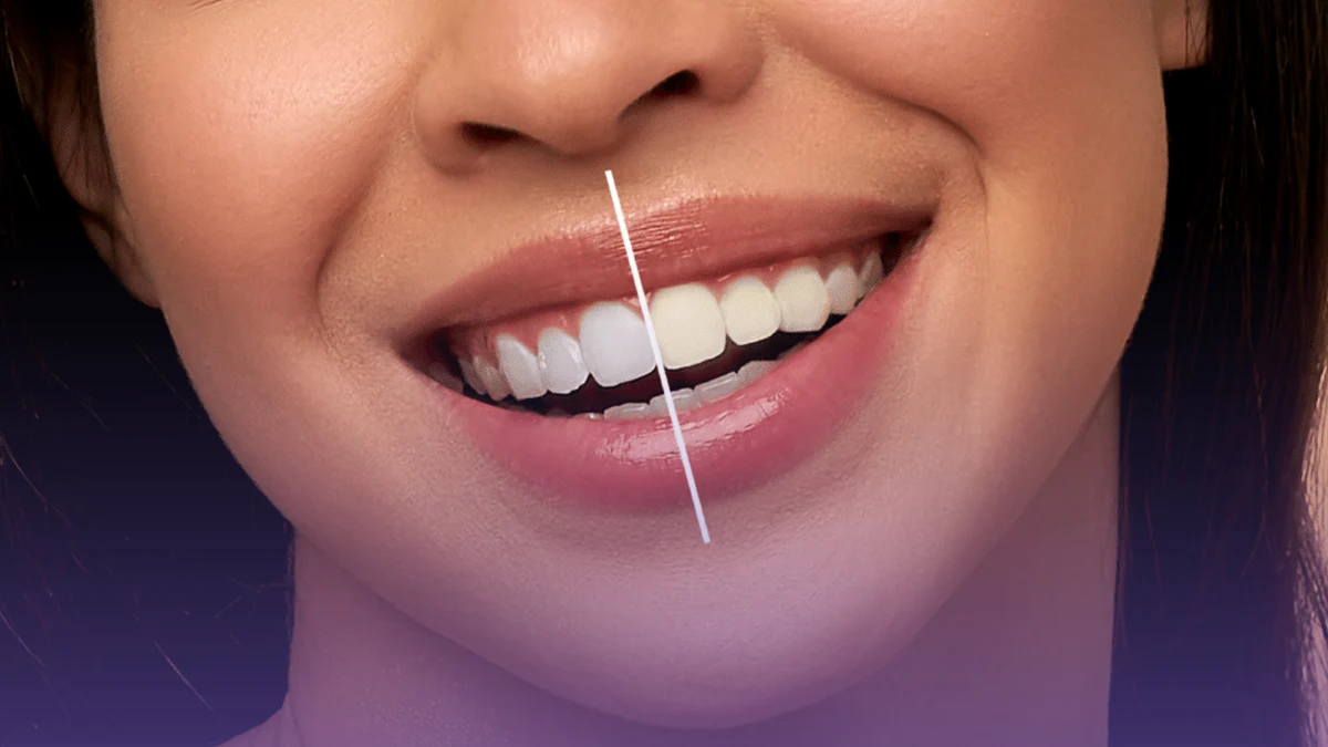 Teeth Whitening in Lucknow: Safe & Effective Bright Smile