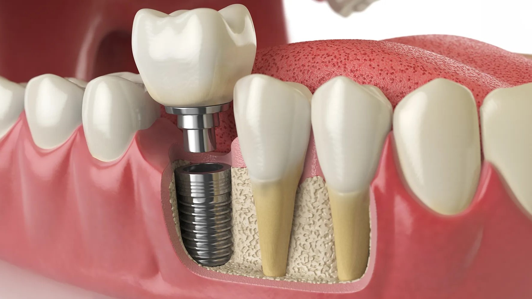Dental Implants Procedure in Lucknow, Benefits, and Cost
